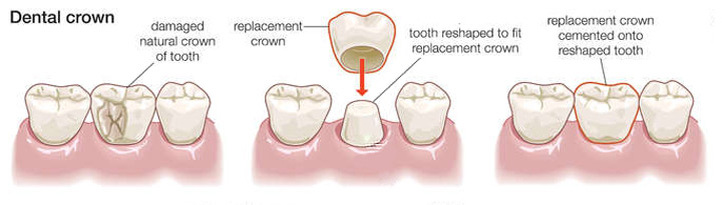 Dental Crowns 2