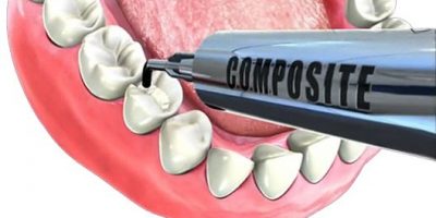 dental composite